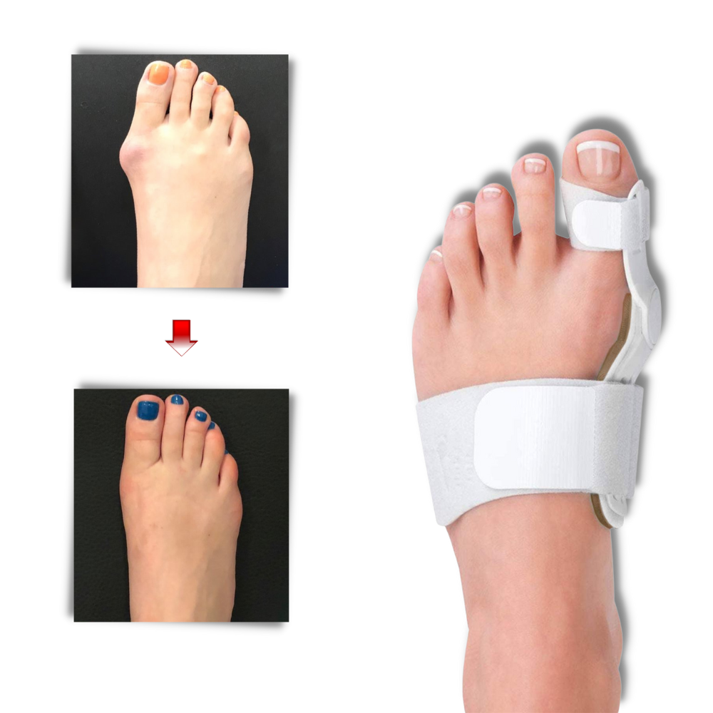 Orthopaedic Bunion Corrector - Ozerty