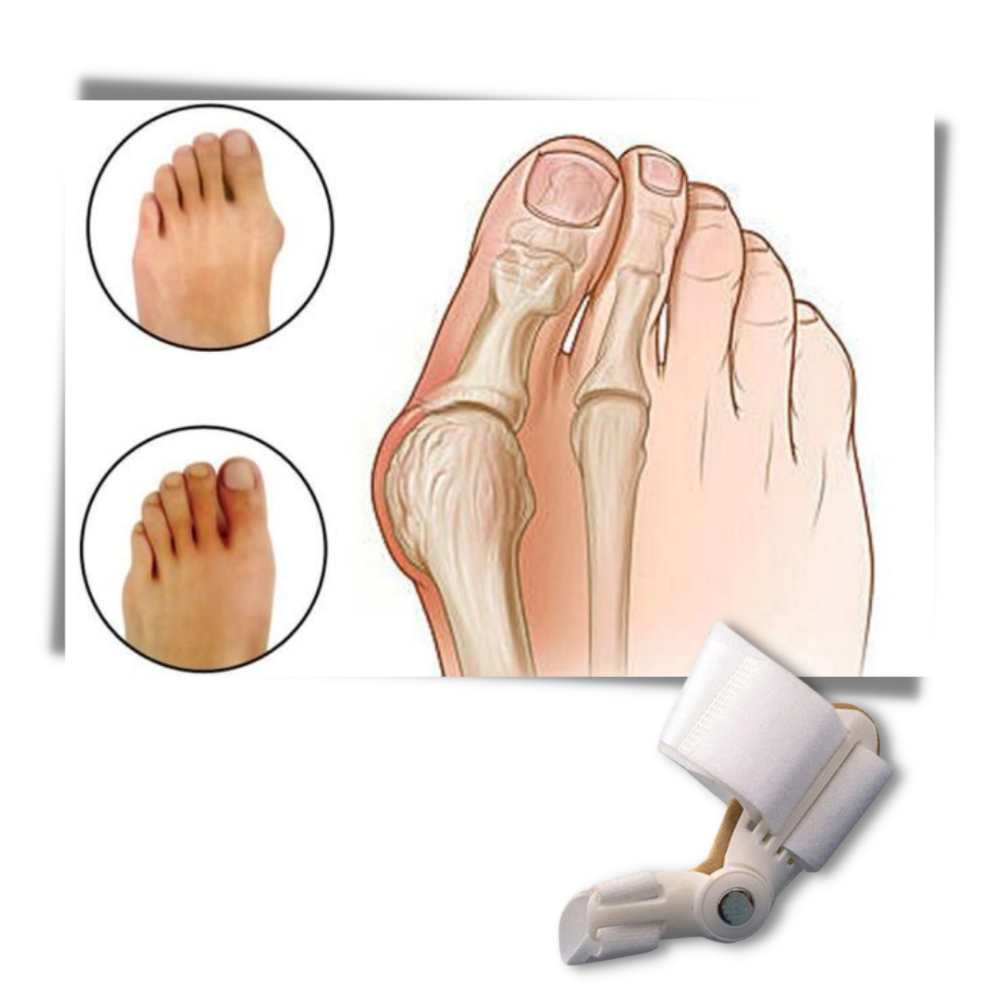 Orthopaedic Bunion Corrector - Ozerty