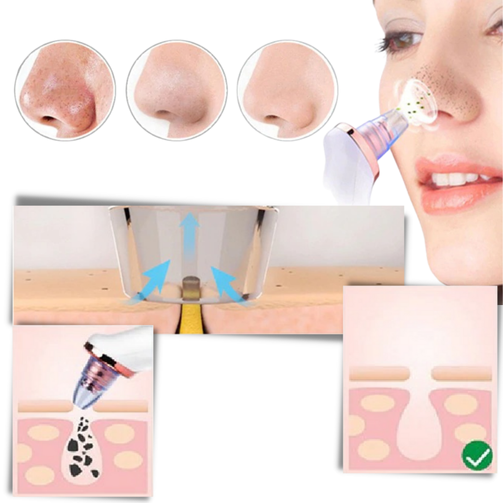 Blackhead Pore Remover Vacuum - Ozerty