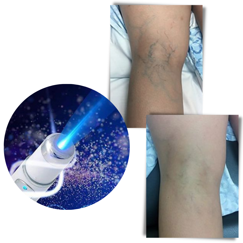 Blue light skin therapy pen - Ozerty