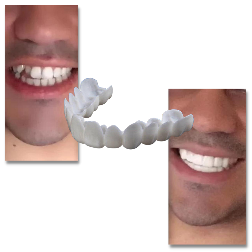 Perfect smile dental coverage - comfortable veneers - Ozerty