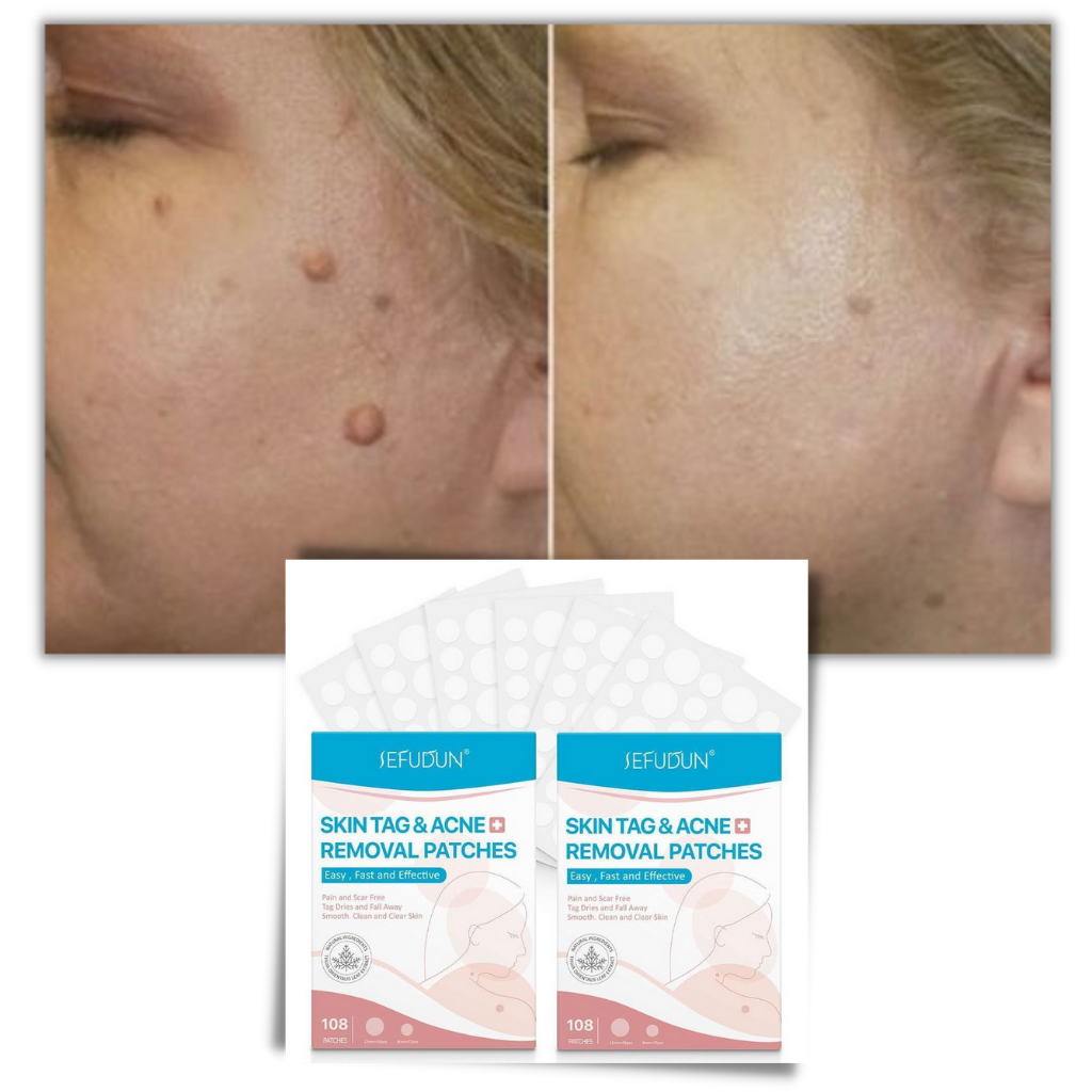 Skin tag removal treatment patch - Ozerty